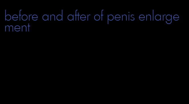 before and after of penis enlargement