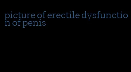 picture of erectile dysfunction of penis