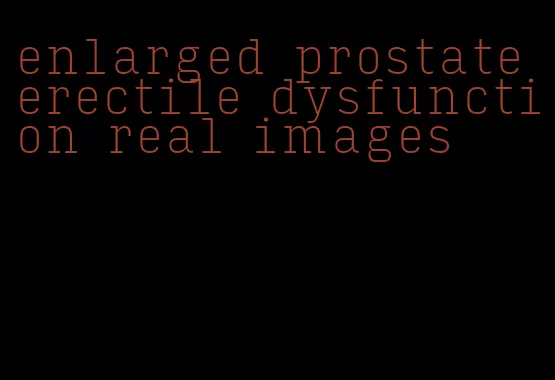 enlarged prostate erectile dysfunction real images