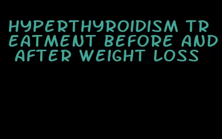 hyperthyroidism treatment before and after weight loss