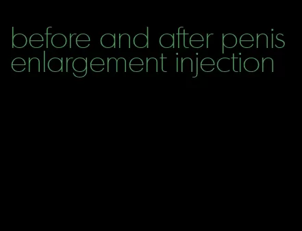 before and after penis enlargement injection