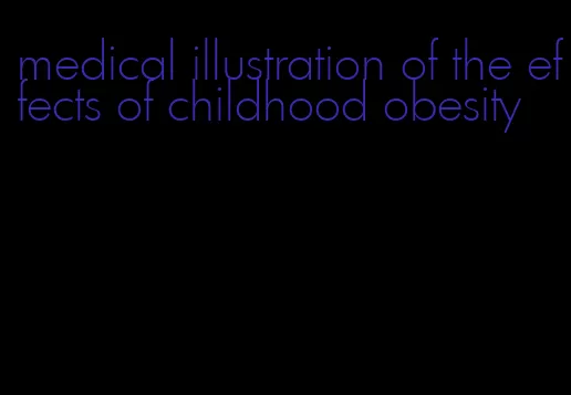 medical illustration of the effects of childhood obesity