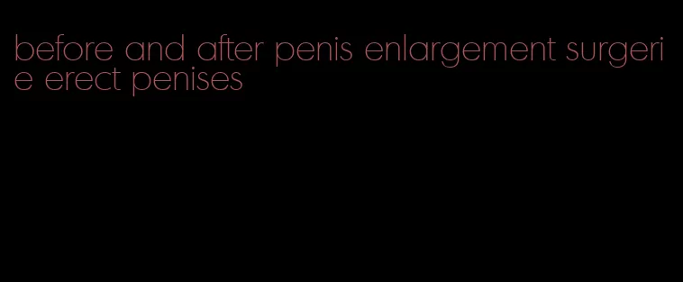 before and after penis enlargement surgerie erect penises